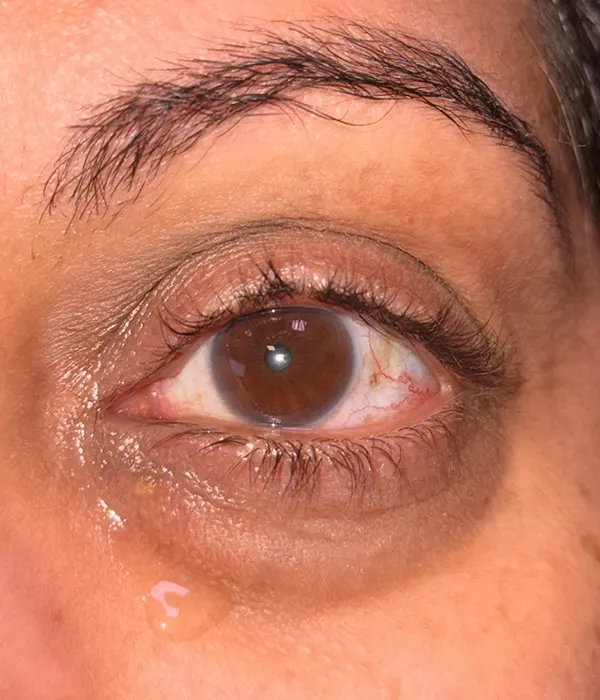 watery eye_600x700